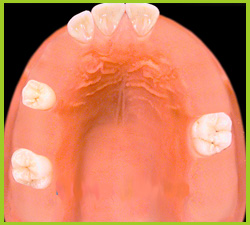 Partial or full denture