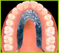 Secondary telescopic crowns built-in to the removable teeth replacement
