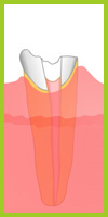Root-treated broken tooth