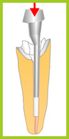 Gluing in post and core artificial cast abutments