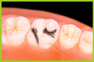 We usually implement the glass-ionomer chemical-polymerization materials to the smaller premolars or molars.